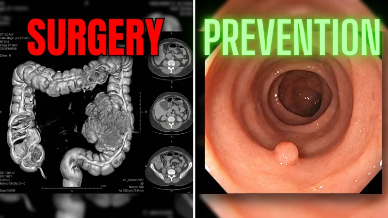 Early Detection and Prevention Intervention for Colorectal Cancer
